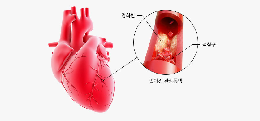 협심증 사진