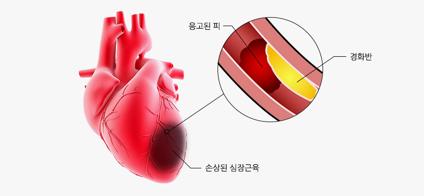 심근경색 사진