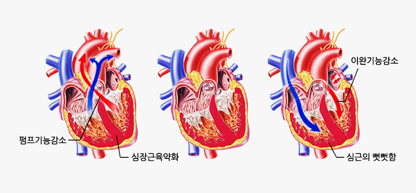 심부전 사진