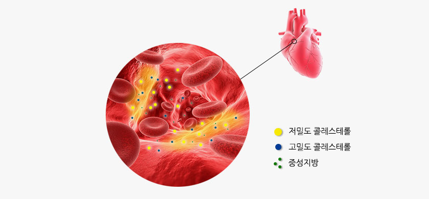 고지혈증 사진