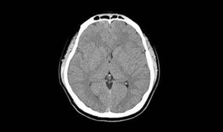 뇌 컴퓨터 단층촬영(CT) 사진