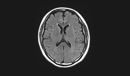 뇌 자기공명영상(MRI) 사진