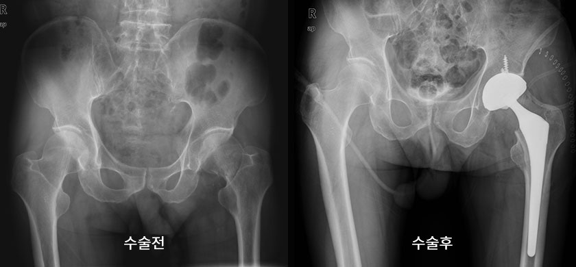 고관절 골절 사진