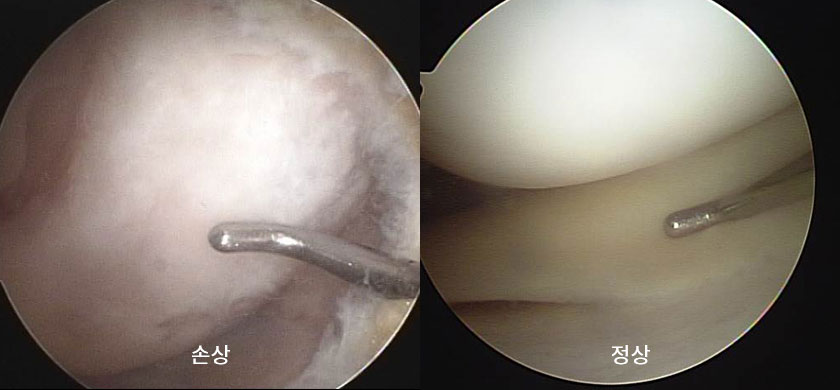 반월상 연골 손상 사진