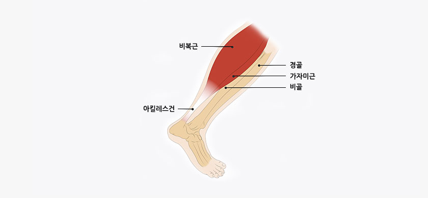 아킬레스건염 사진