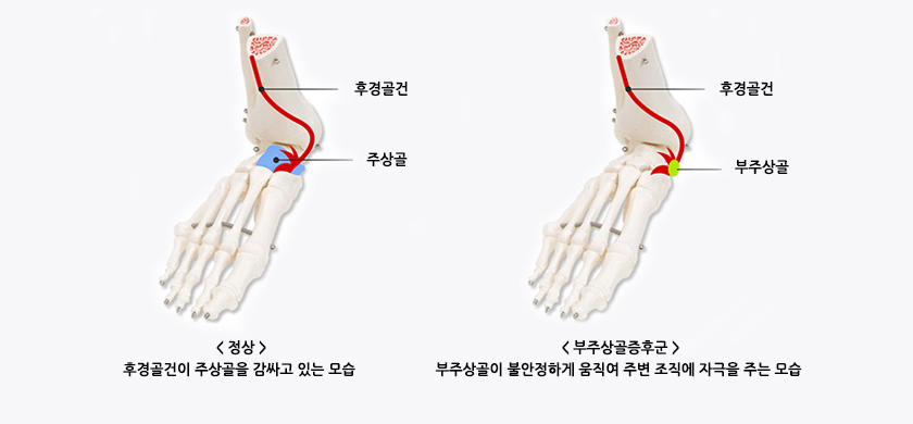 부주상골증후군 사진