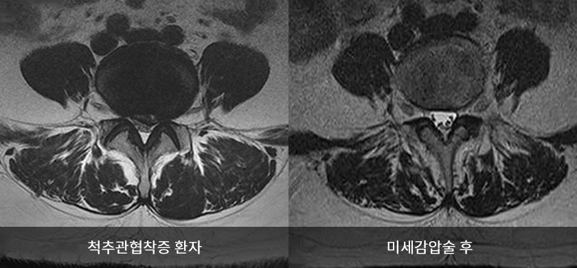 척추관협착증 사진