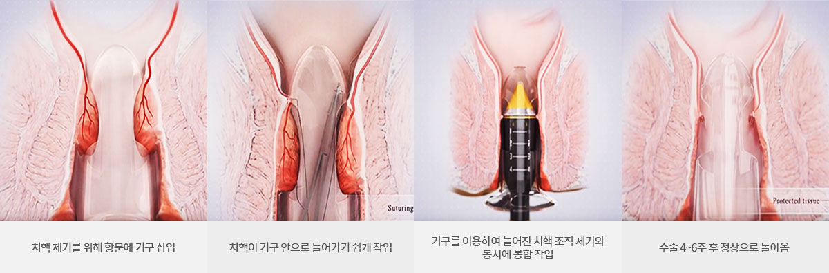 TST 수술 사진